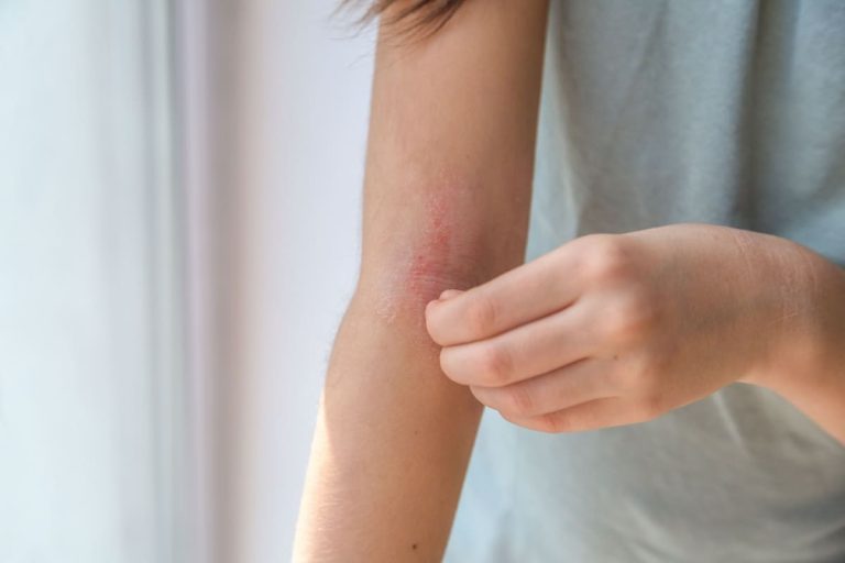 Cum să calmezi mâncărimea cauzată de dermatita atopică?