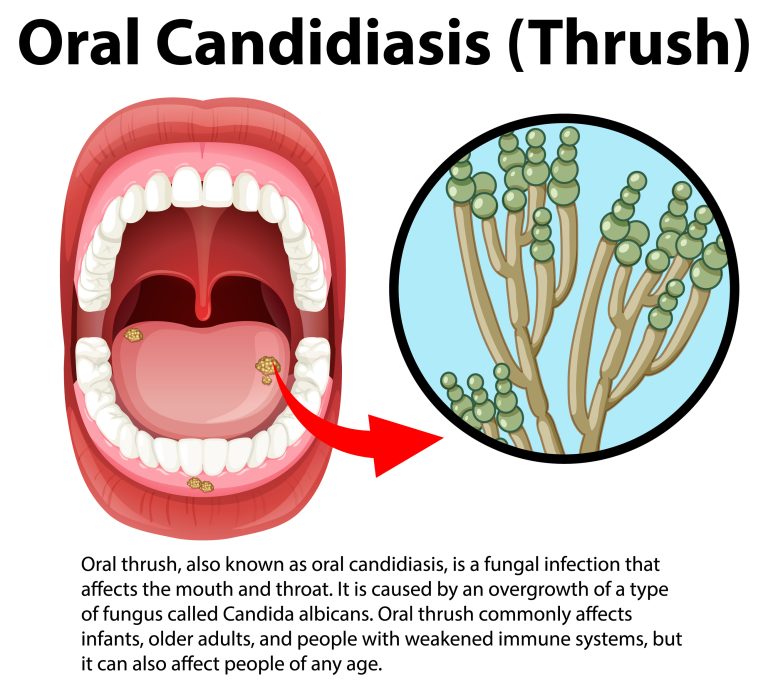 Candidoza bucală – cum se manifestă și cum o pot trata